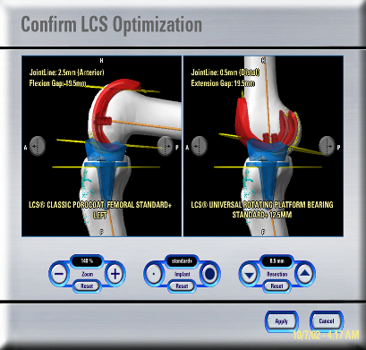 Total Knee Replacement Computer Plan